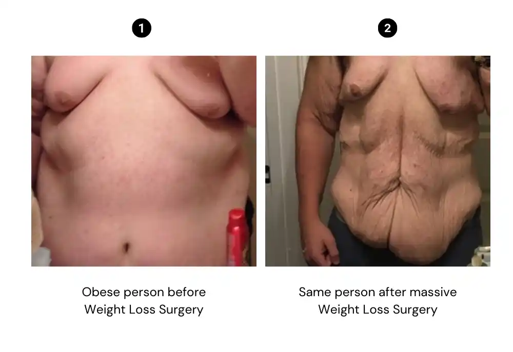 Before-and-after of an individual undergoing weight loss surgery